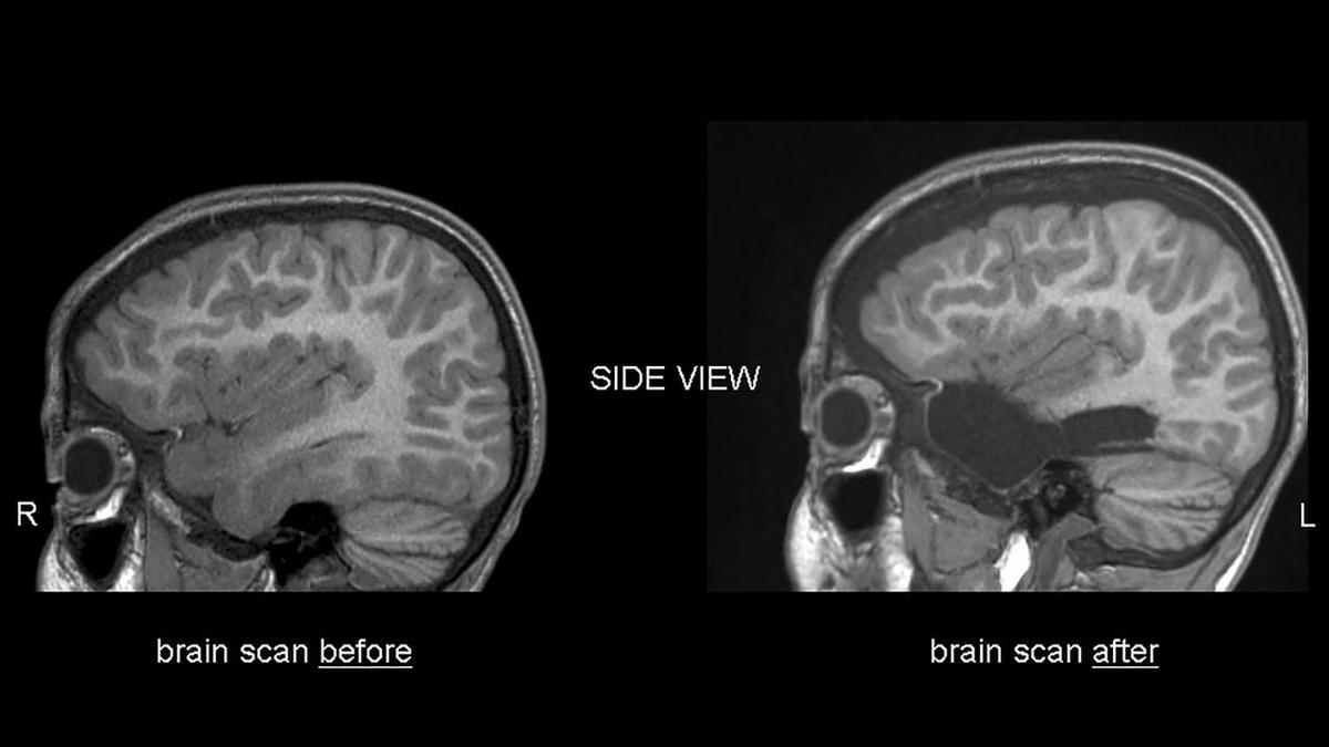 Aussie imaging agent to help brain cancer patients