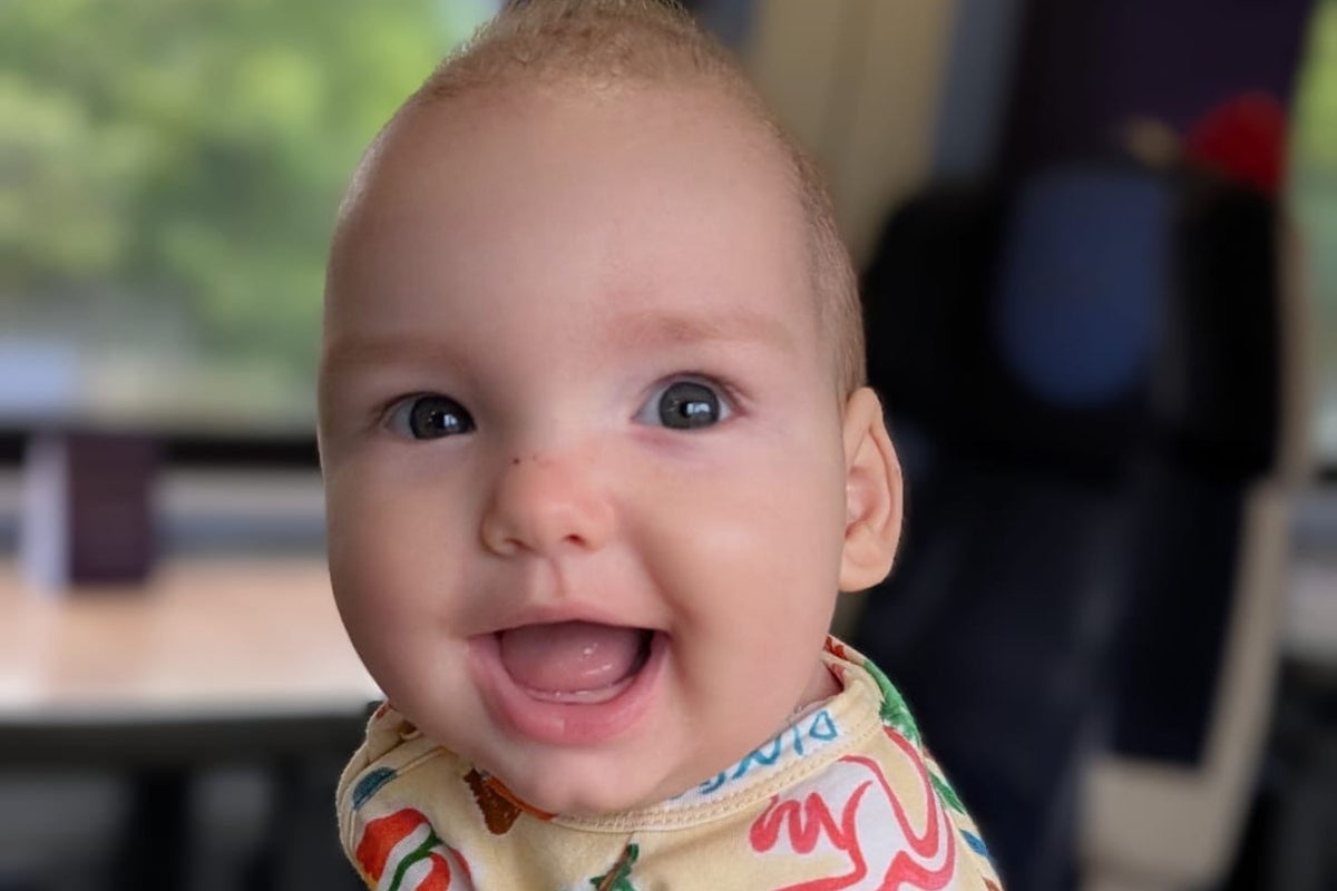 Baby given world-first treatment involving ‘super-elastic springs’ to reshape skull