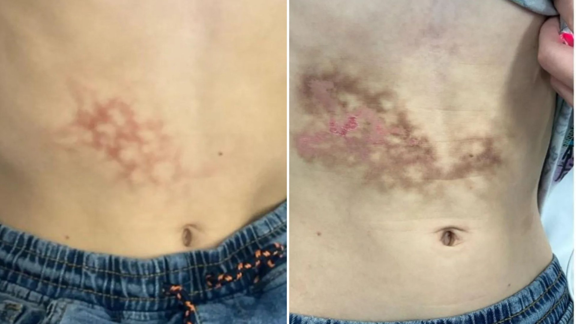 Horrifying pics reveal why gaming and YouTube for hours on end is putting kids at risks of burns