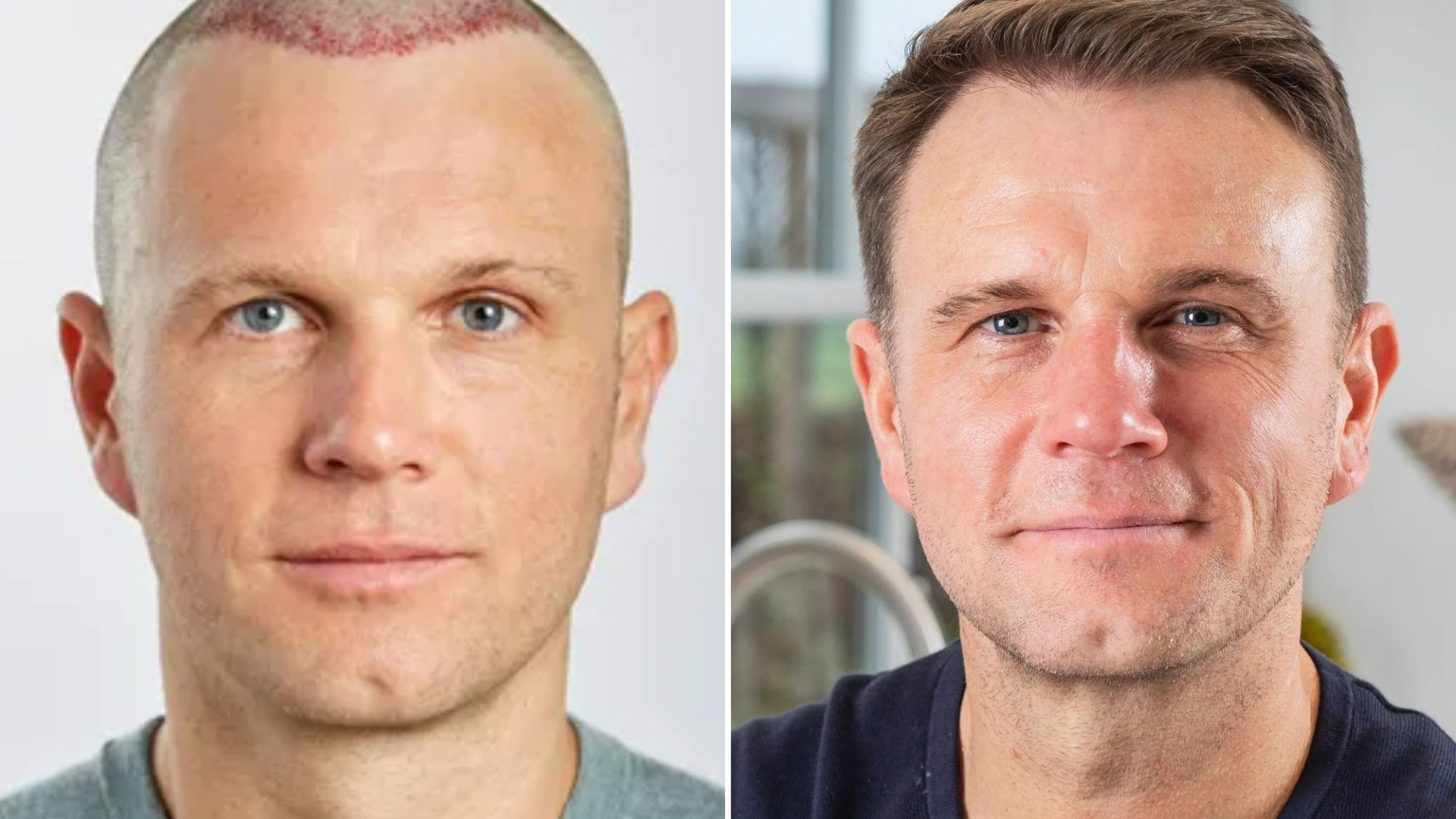 I spent £40,000 on 13 hair transplants after going bald at 21 – pals mocked me but don’t make the same mistake I did