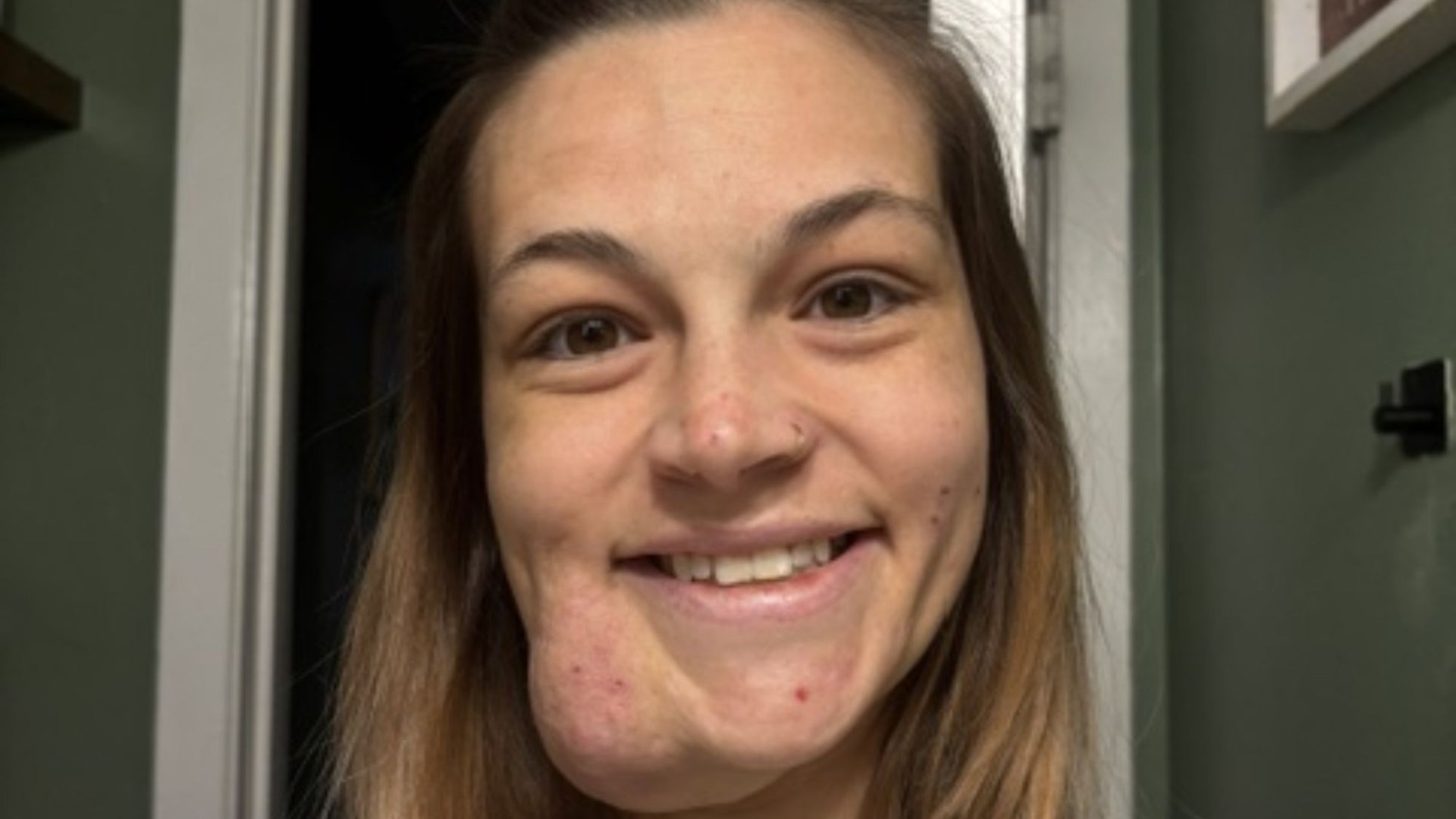 I squeezed a pimple on my face before it grew to a permanent, throbbing growth for 19 years – trolls call me Quagmire 