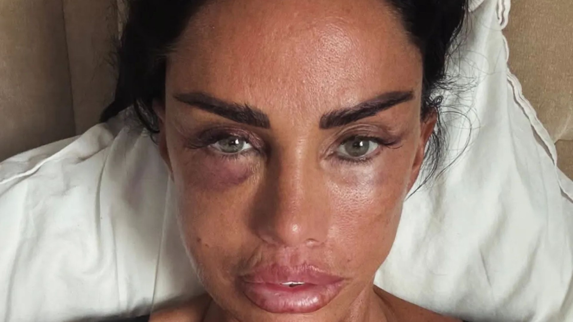 Katie Price shows off her bruised and swollen face as she reveals latest cosmetic treatment – and defends NTAs look
