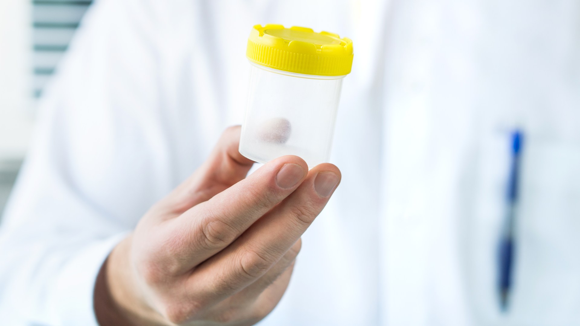 New at-home pee test detects 9 in 10 bladder cancer cases – sparing thousands invasive checks