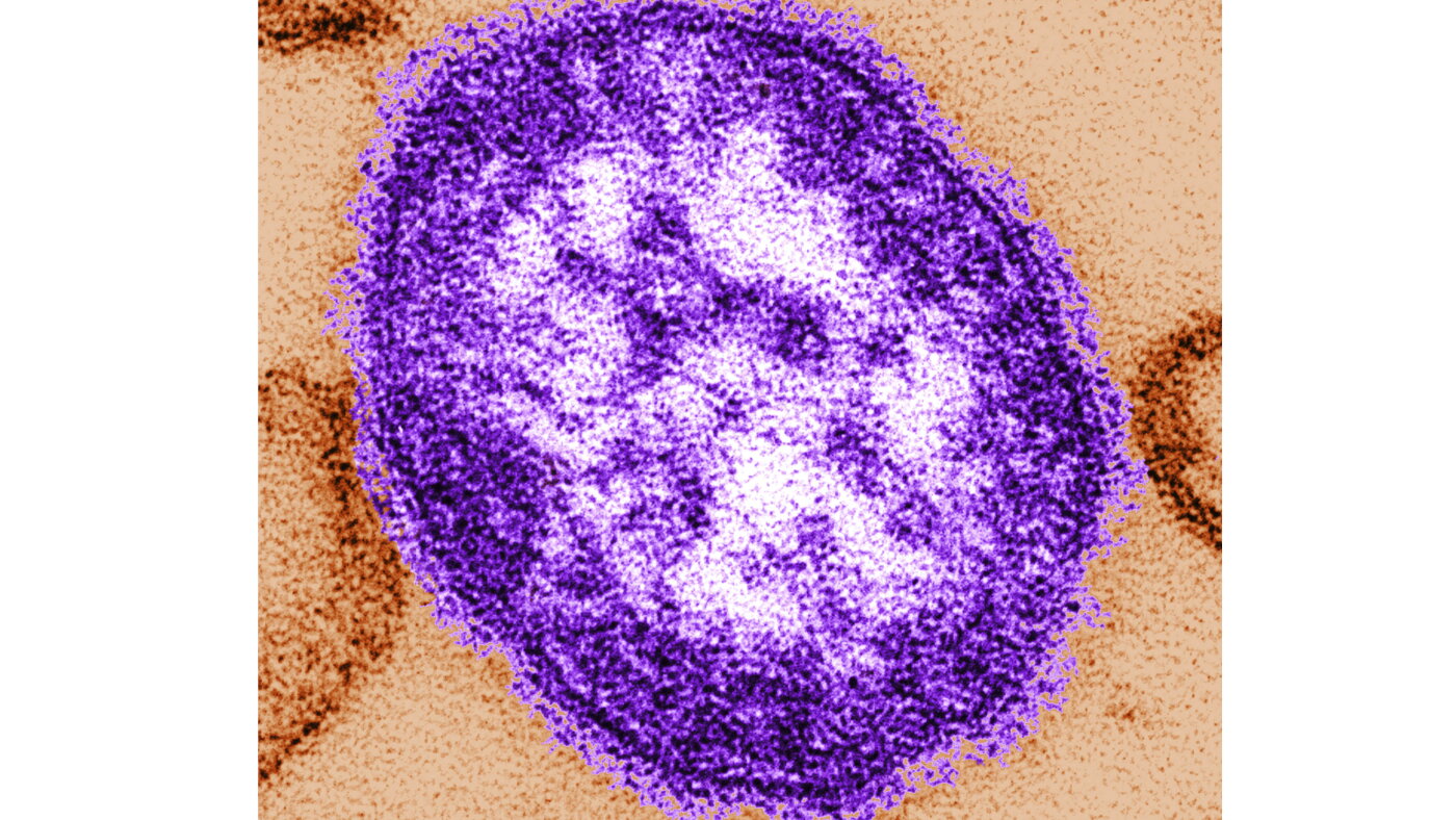 Pennsylvania says an unvaccinated woman has died from measles-related complications