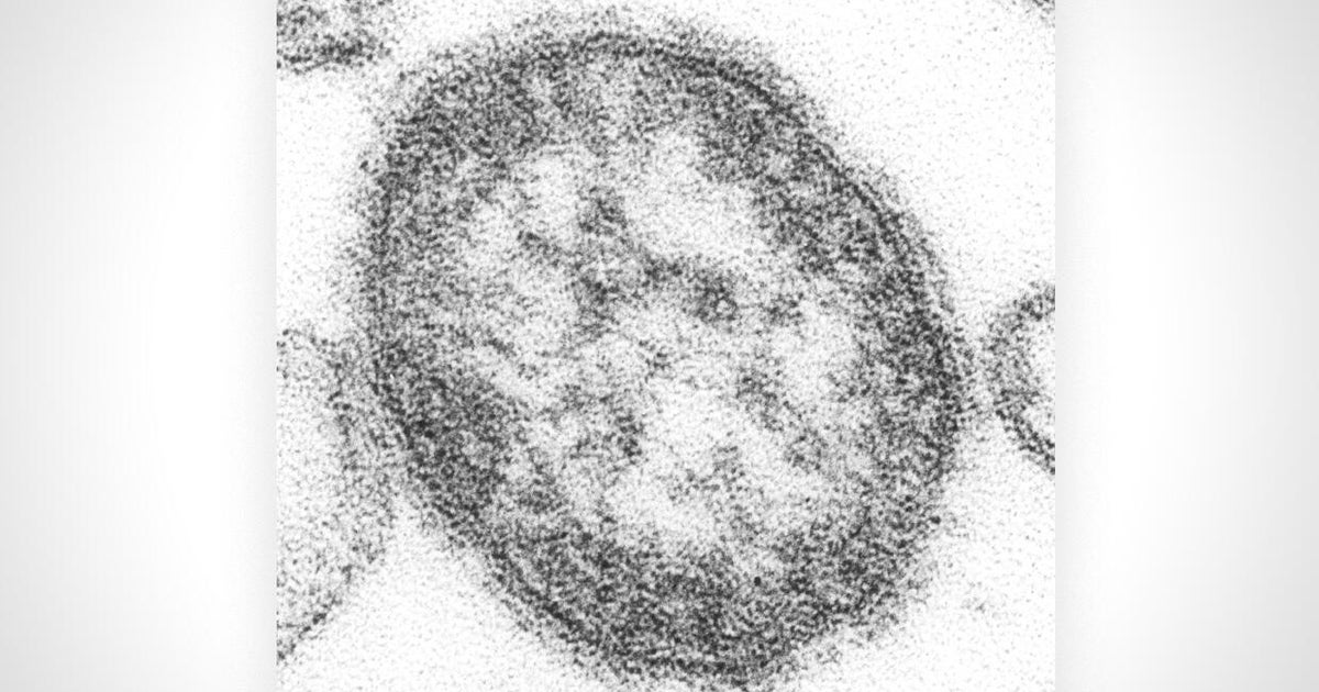 Pennsylvania woman dies of measles complications, coroner reports