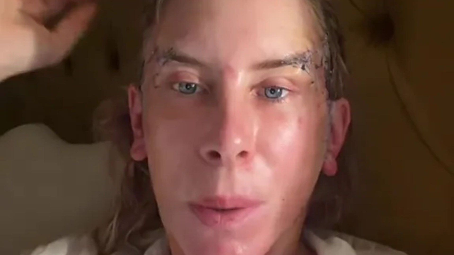 Real Housewives star reveals bloodied and stitched face after surgery and reveals she’s had no pain killers