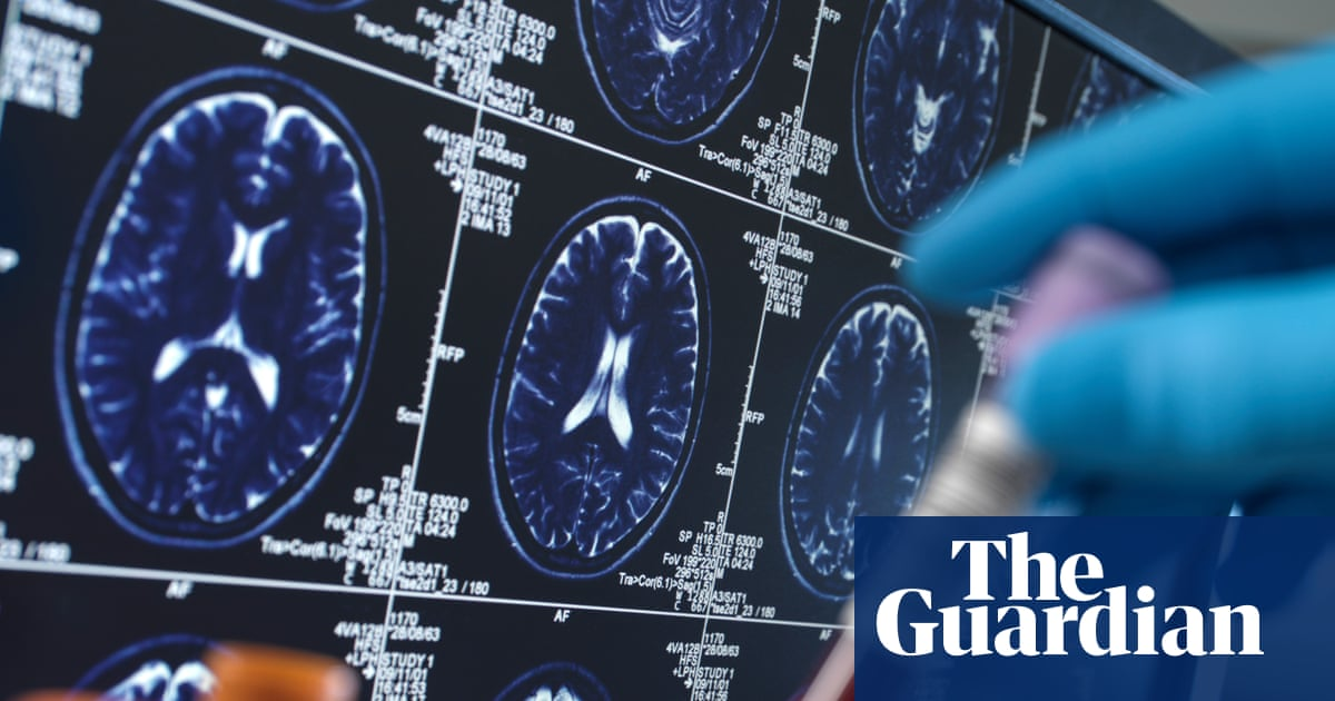 Researchers warn social media driving harmful misuse of Alzheimer’s blood tests