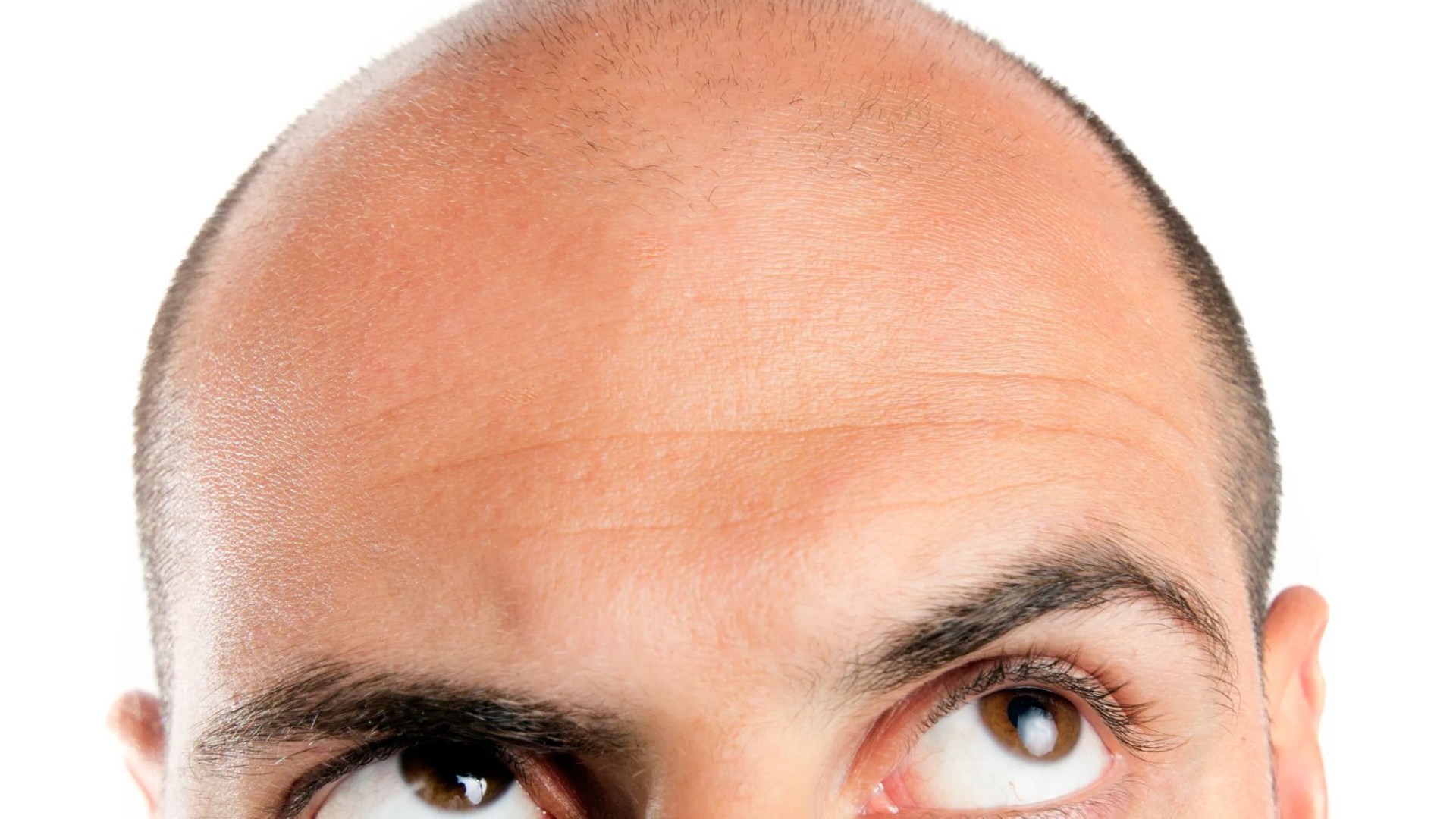 Weight-loss jabs like Wegovy or Mounjaro can spark hair loss in men by triggering baldness genes, scientists warn