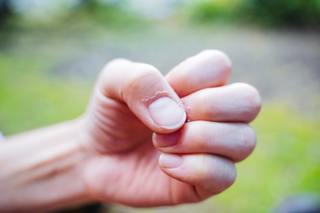 What different changes to your fingernails can reveal about your health